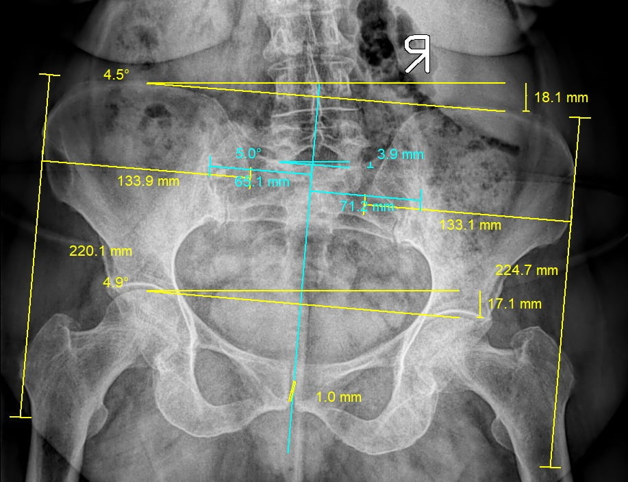 digital xray imaging for pelvic pain