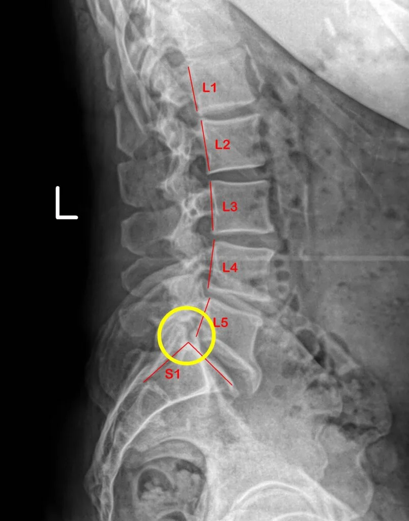 Sciatica Treatment Kuala Lumpur, Malaysia