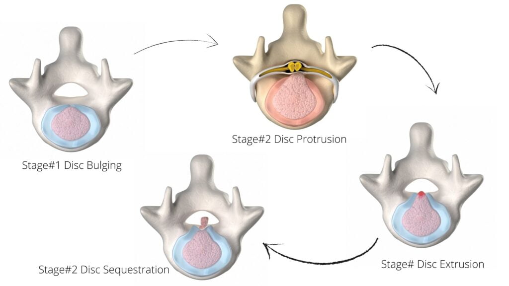 stages of herniated discs