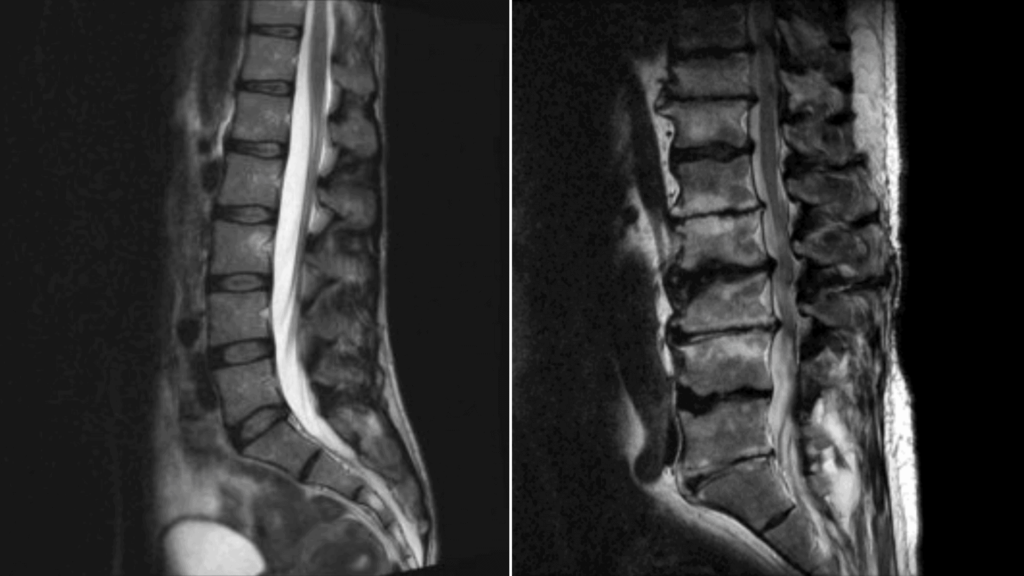 degenerative disc disease