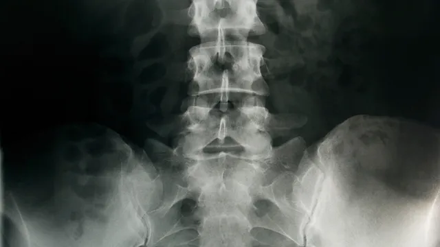 slipped disc xray