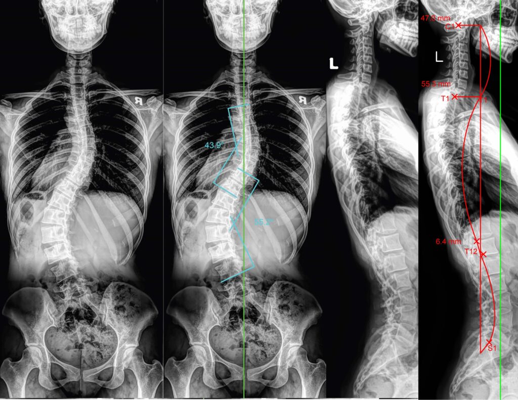 Full spine X ray