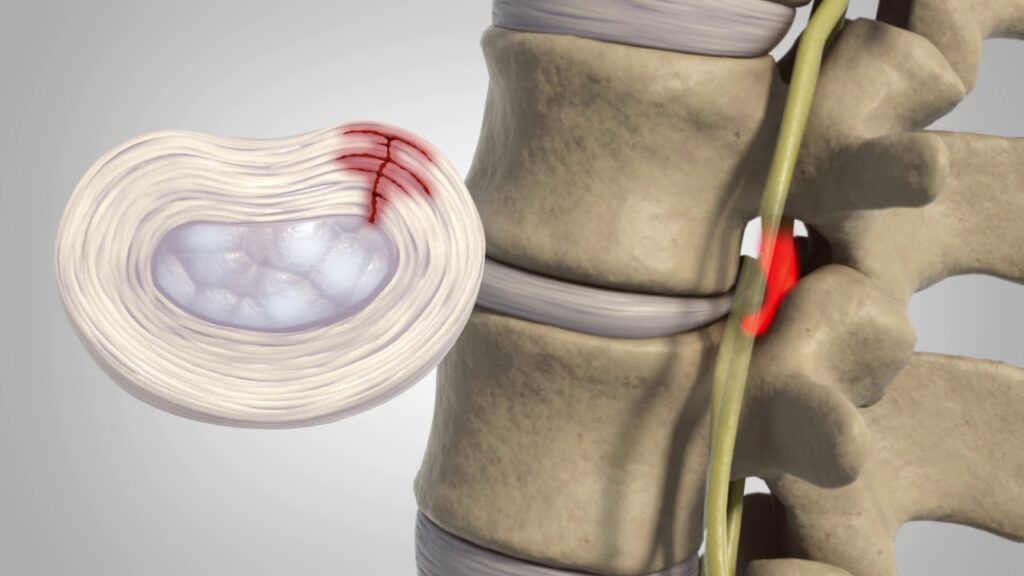 prolapsed intervertebral disc