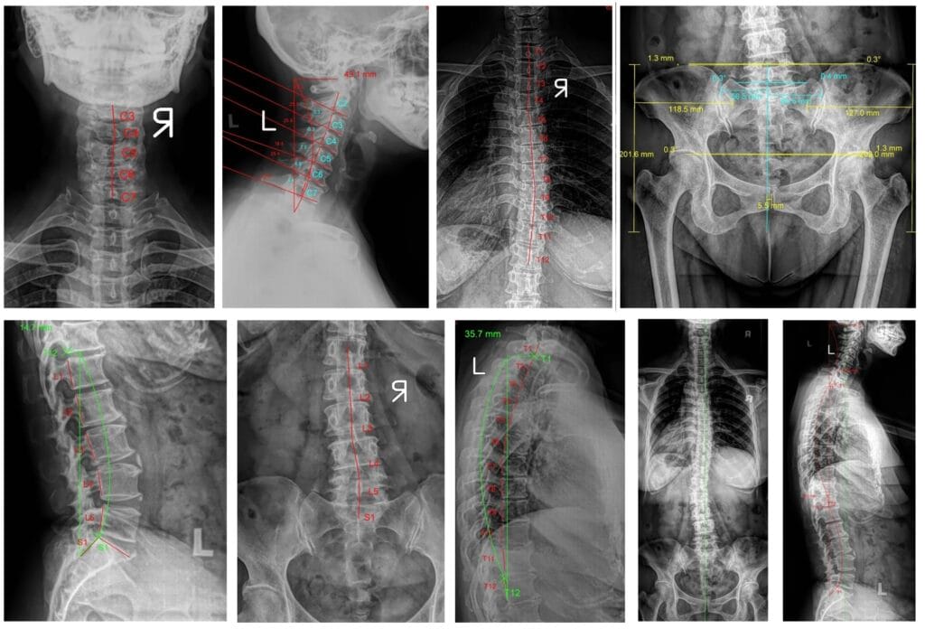 Osso Bone Care Full Spine X ray